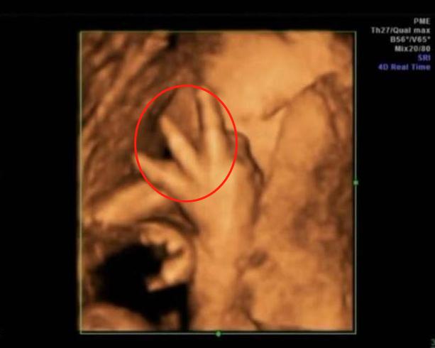 澶╂墠鑳庡効瀹岀粨,澶╂墠鑳庡効