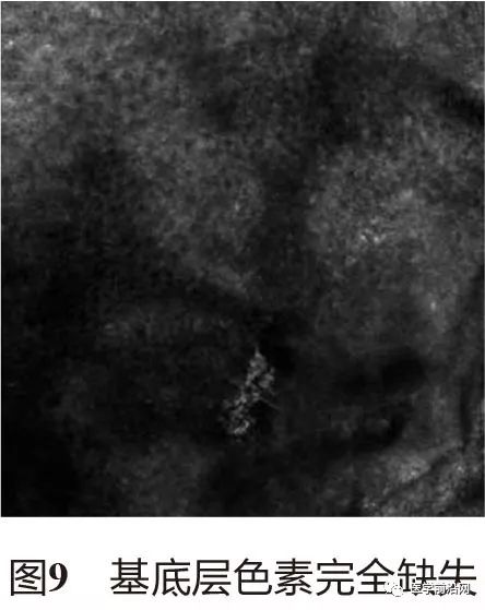 皮肤共聚焦显微镜能查什么,皮肤镜和共聚焦显微镜