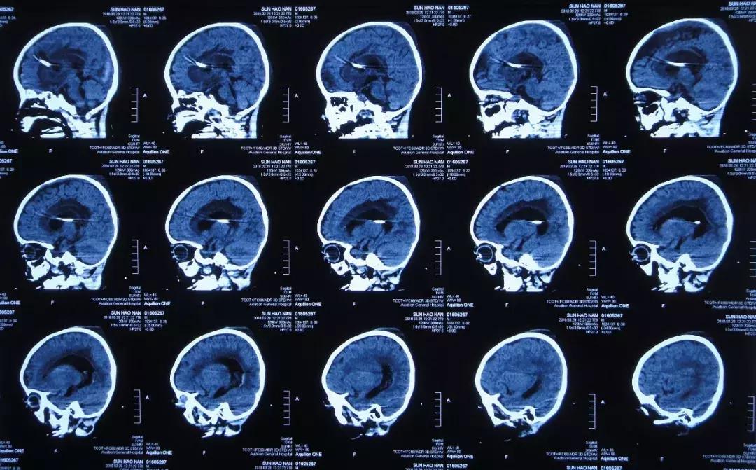 孩子脑积水反复发烧,婴儿脑积水引起发烧如何保守治疗