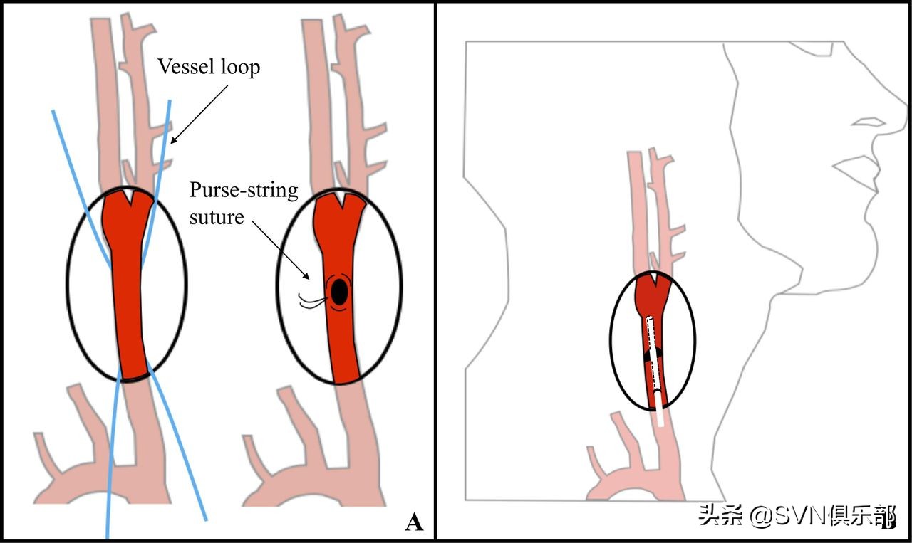出版简讯｜直接颈动脉穿刺治疗急性缺血性卒中