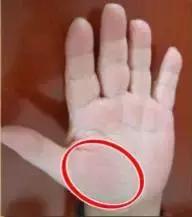 手上7个小细节竟然暗藏大健康,手诊10种常见病从手上就能看出来