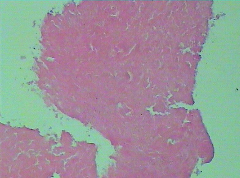 乳腺梭形细胞恶性肿瘤高级别,乳腺梭形细胞肉瘤