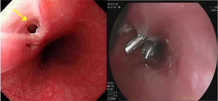 一碗鱼汤,让她反复咳嗽、发烧,还发生了食管、气管“短路”