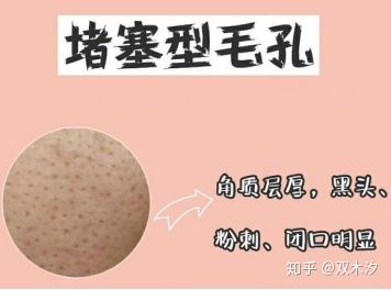 毛孔粗大到底怎么有效解决,毛孔粗大有哪几种类型