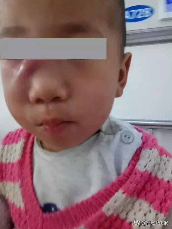 小孩牙齿蛀了一个小洞,四岁男孩牙齿全被虫蛀