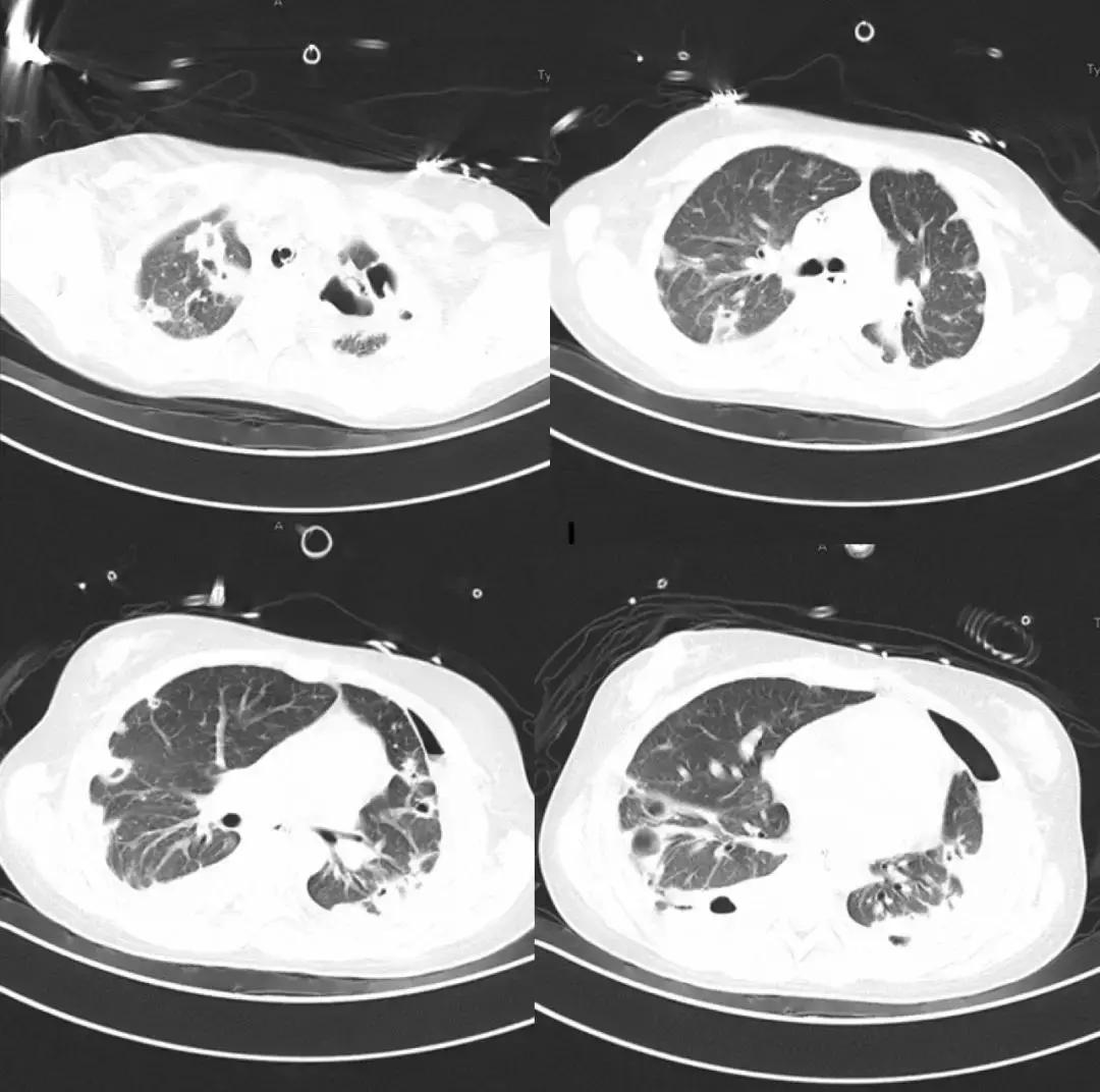 万古霉素治疗mrsa疗程,万古霉素用于mrsa的作用机制