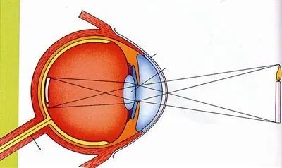 视网膜色素变性患者眼中的世界,视网膜色素变性有最新治疗方案吗