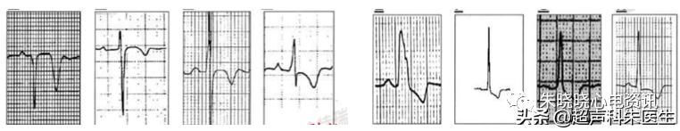 t波倒置9个真相图解,t波倒置判断口诀