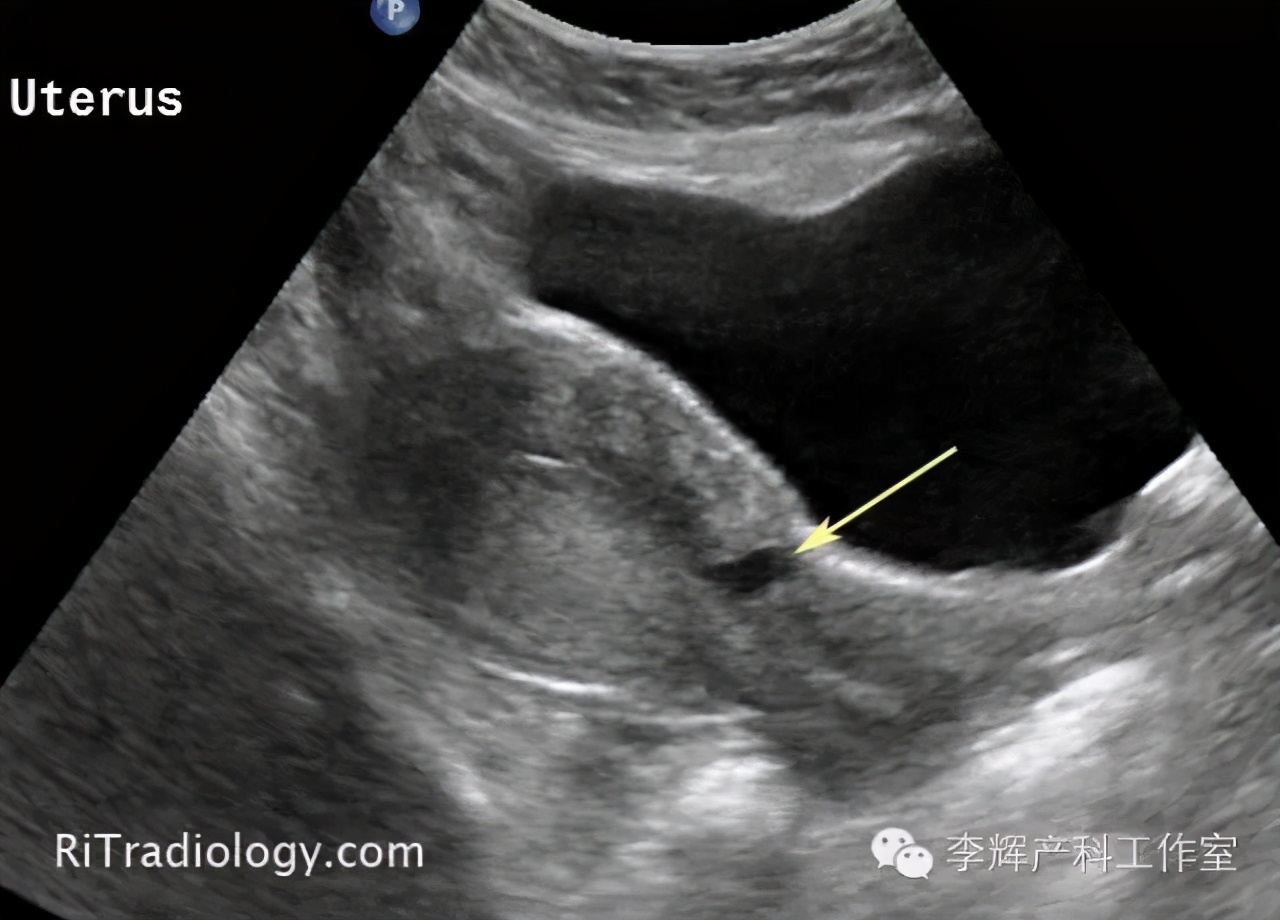 剖宫产憩室手术知情同意书,剖宫产手术同意书