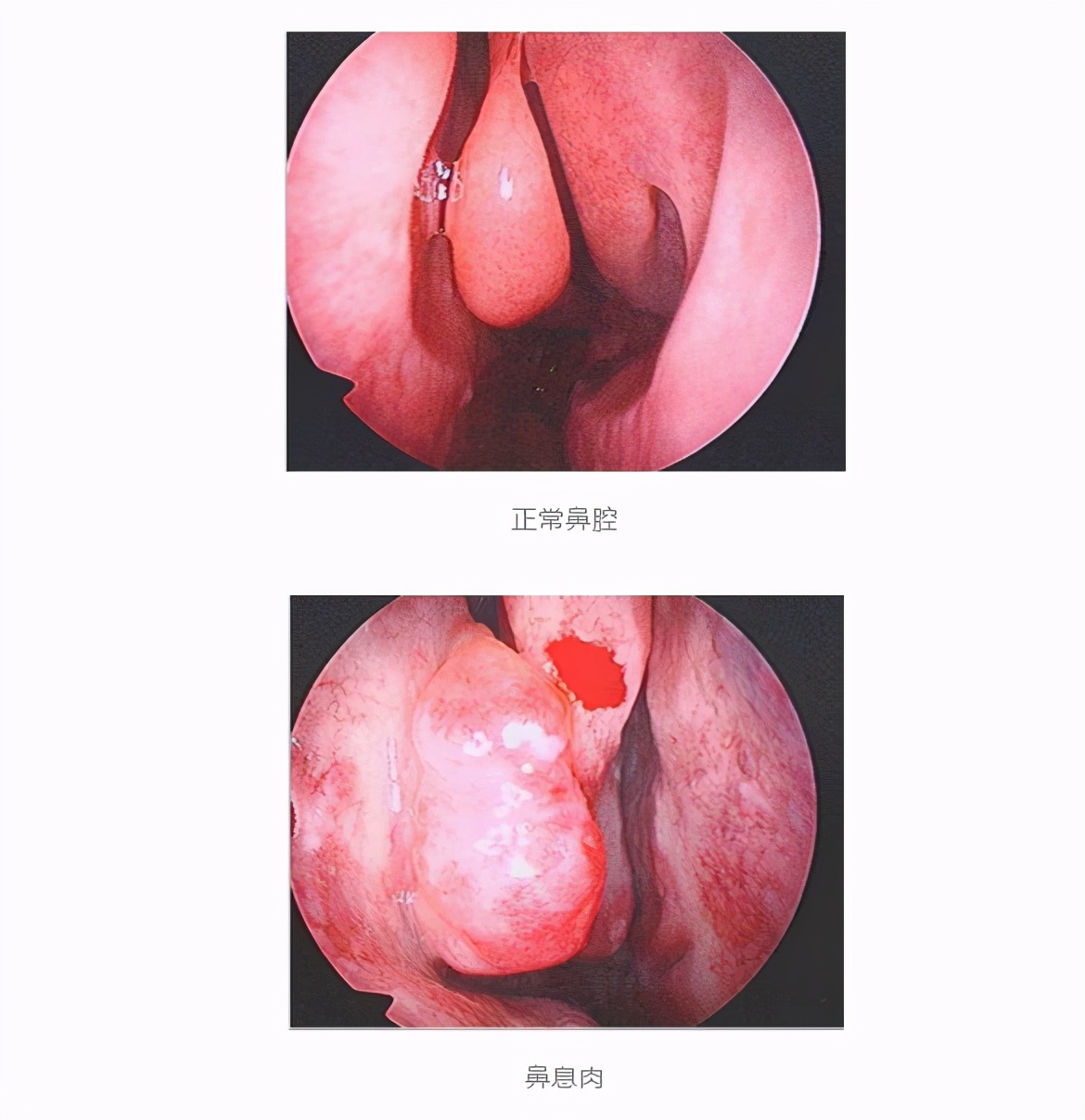男子鼻塞流清涕,鼻子里长了个疙瘩一直流鼻涕