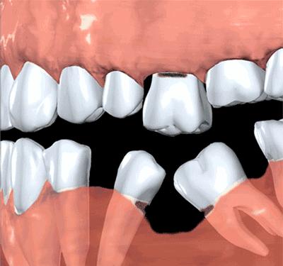 做种植牙必须要具备这些条件,种植牙的缺点哪些人不适合种植牙