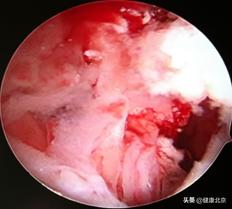 年轻女性容易得的重大疾病,子宫内膜癌饮食注意什么