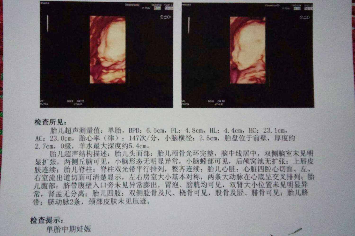 四维彩超能看出宝宝什么信息,四维彩超怎么看出胎儿的信息