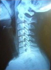 青少年颈椎痛怎么治,青少年父母要注意什么