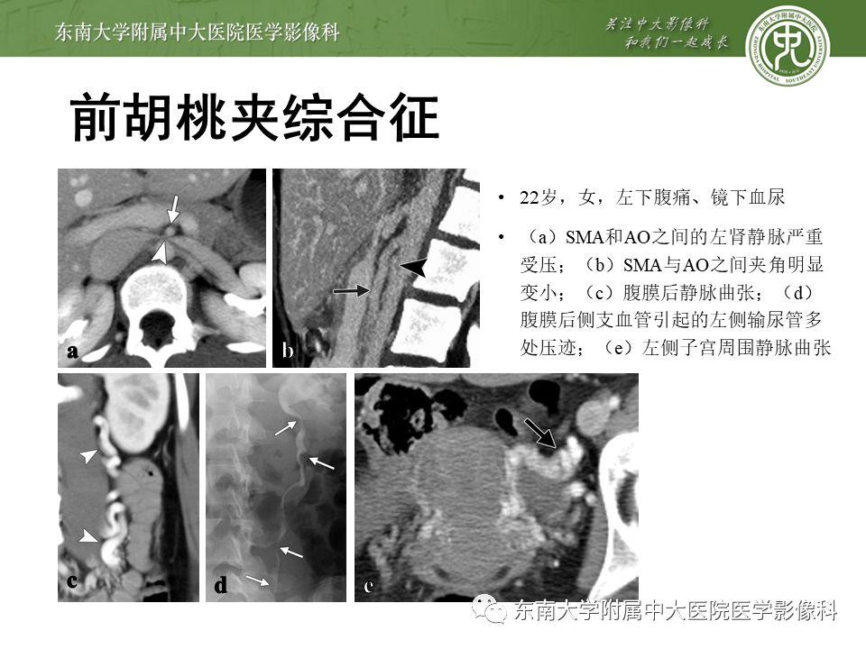 肠系膜上动脉压迫综合征挂什么科,肠系膜上动脉压迫综合征手术费用
