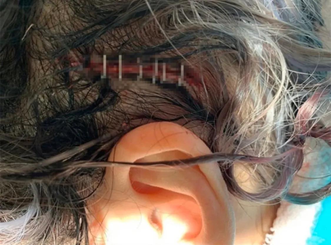 萧亚轩晒昔日头部受伤照片，头部裂开一道口子，伤口触目惊心