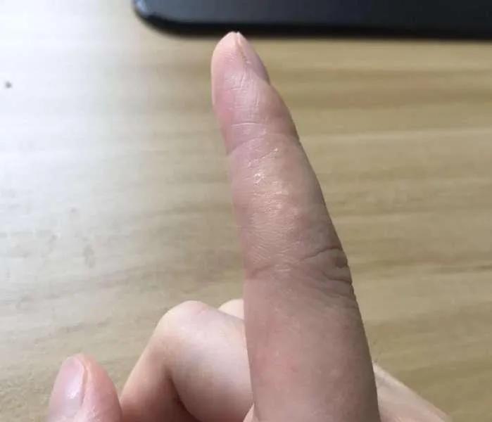 黄sir说护肤品,中医讲汗疱疹是什么原因