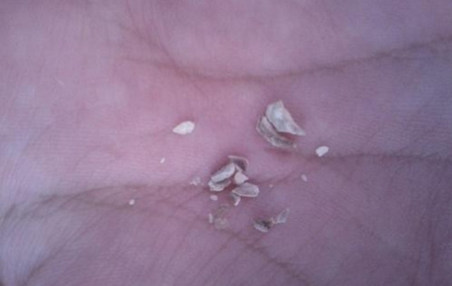 用手抠掉黑色的牙结石,有啥办法能抠掉牙结石