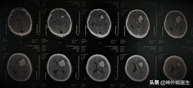 球囊扩张血肿怎么办,经皮穿刺脑血管腔内球囊成形术