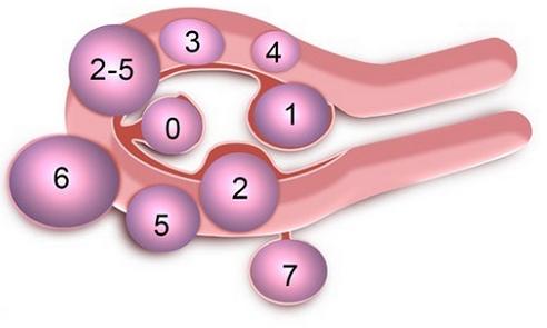 子宫肿瘤医院全国排名,子宫肌瘤分几种类型