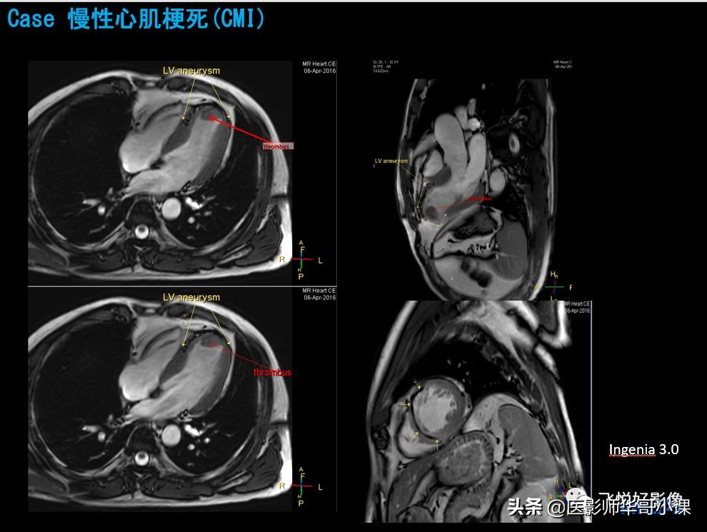 飞利浦核磁共振快速扫描,飞利浦磁共振心脏扫描