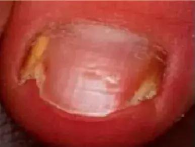 足疗店灰指甲治疗费用大概多少钱,得了灰指甲一个传染俩靠谱吗