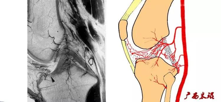 膝盖扭伤前交叉韧带损伤可以热敷,前交叉韧带扭伤最快自愈方法