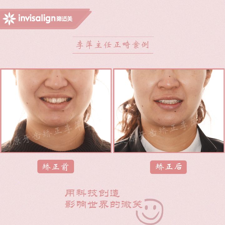 太原矫正牙齿需要做正颌吗,太原牙齿二次矫正