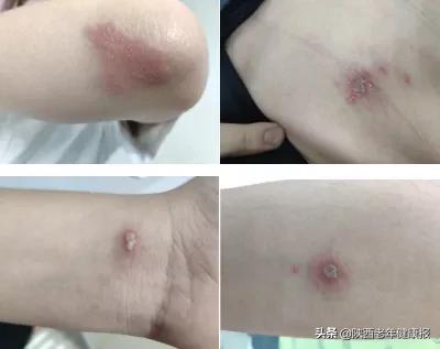 毒隐翅虫怎么来家里的,毒隐翅虫最佳治疗方法