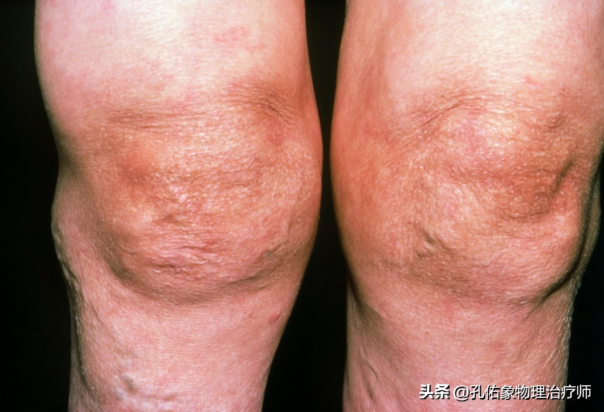 治膝痛的锻炼方法,膝痛康复动作