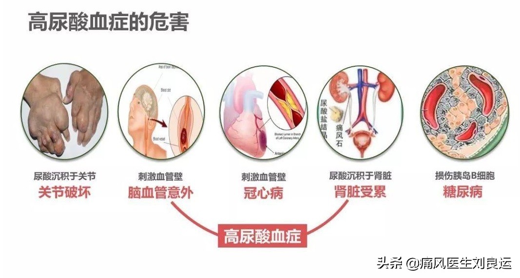 高尿酸没有症状到底要不要吃药,尿酸偏高怎么让尿酸下去