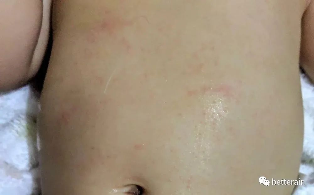 宝宝湿疹发作,痒痛到又哭又叫,直到betterair出现
