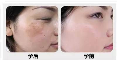 怎么改善斑点和暗黄,褐青色斑和雀斑哪个容易治疗