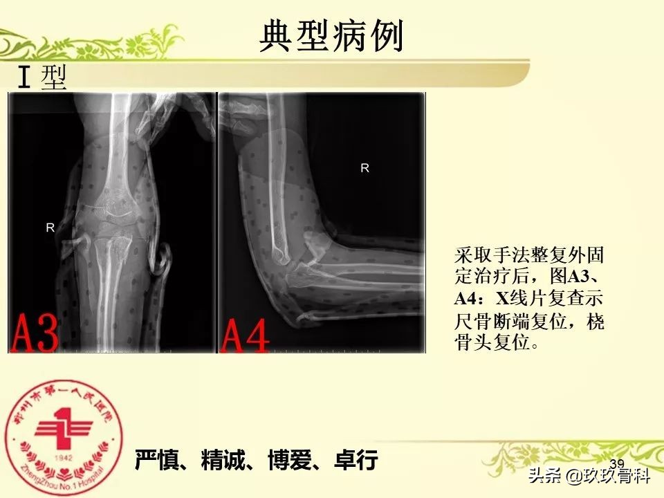 孟氏骨折功能训练多久能恢复正常,孟氏骨折中医能治吗