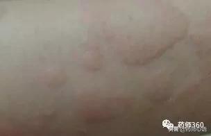 麻疹有什么中成药,常见人工荨麻疹的治疗方法有哪些