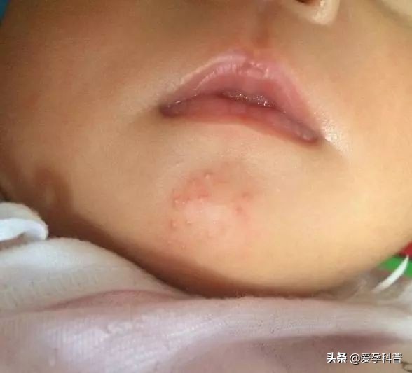 宝宝长湿疹是因为“胎毒”？家长若不做这4件事，湿疹就难治了