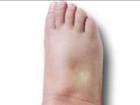 孕期水肿到大腿怎么办,孕期水肿