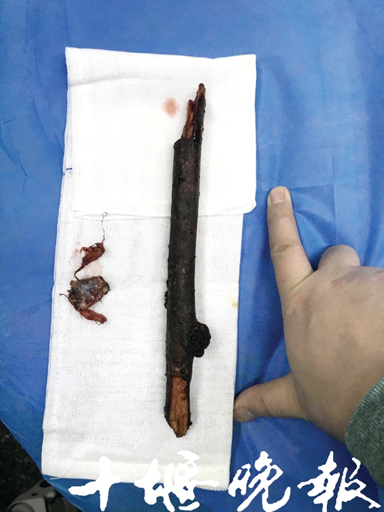 十堰女子上树摘樱桃跌落灌木丛30厘米长断枝插进*体下**