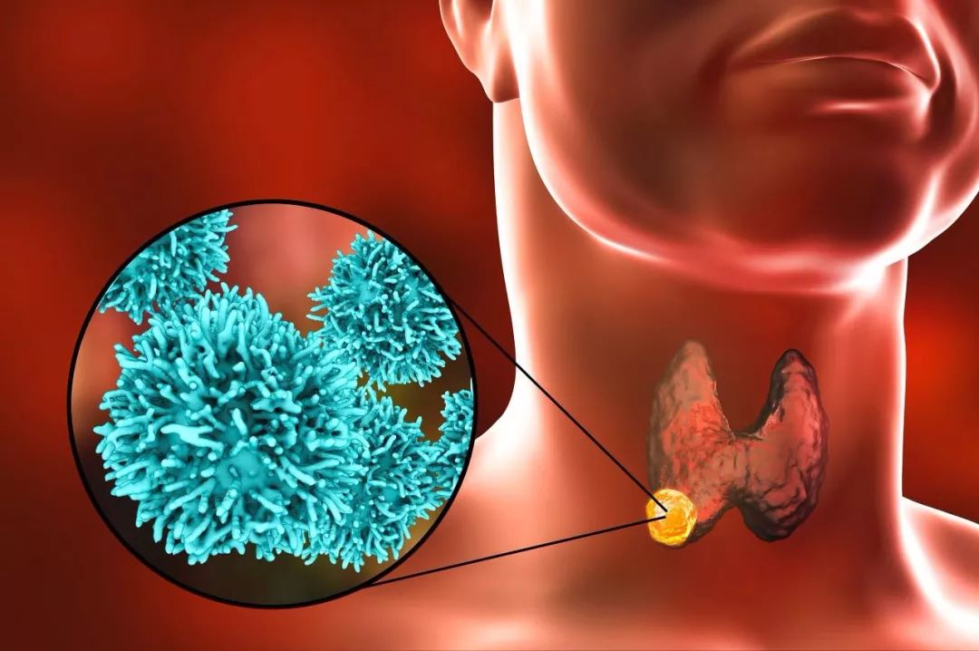 中西医对甲状腺癌病机、诊断与治疗方法解析