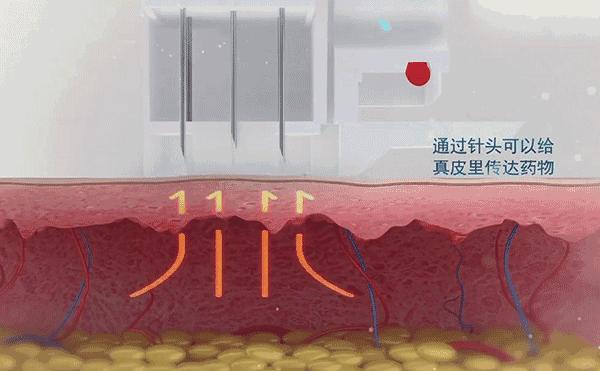 机打水光针好吗,机打水光针一般多少时间