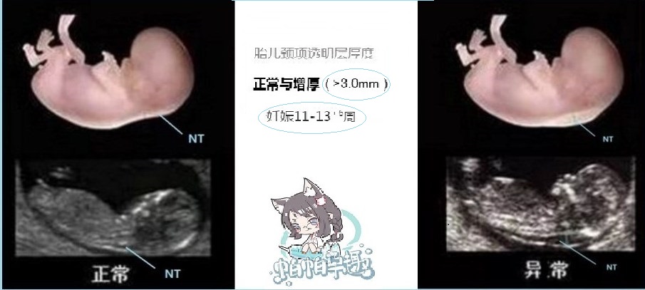 超声检查NT异常，该怎么办？