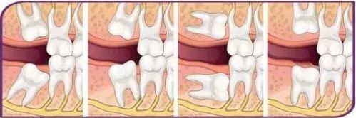 拔智齿痛苦的真实经历,拔智齿去了3次花了近1千