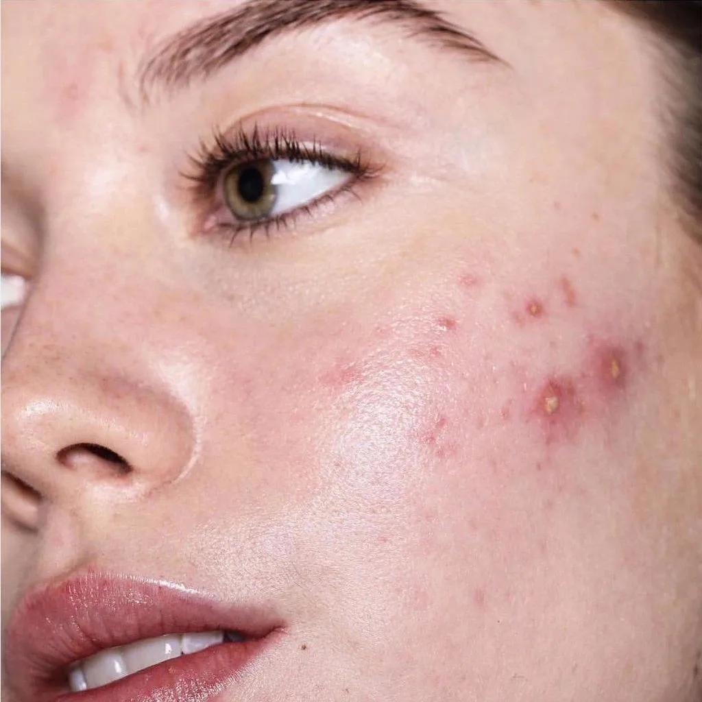 每到换季就会爆痘,换季时爆痘