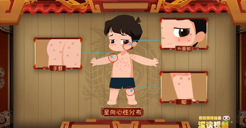 水痘只要不抓破可以挠痒吗,水痘什么时候开始挠破