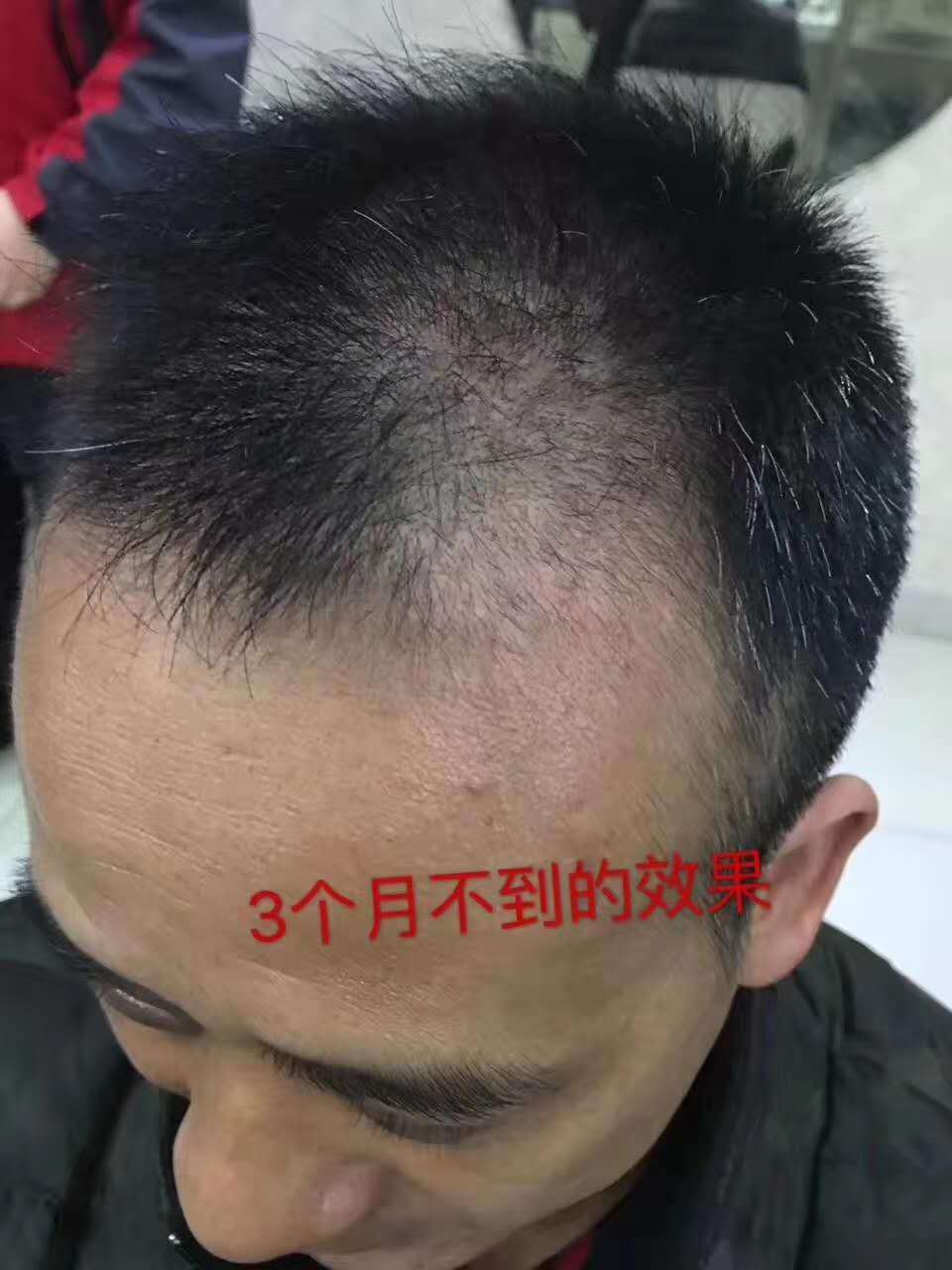 脂溢性脱发治疗脱发成功案例,脂溢性脱发如何生发最有效
