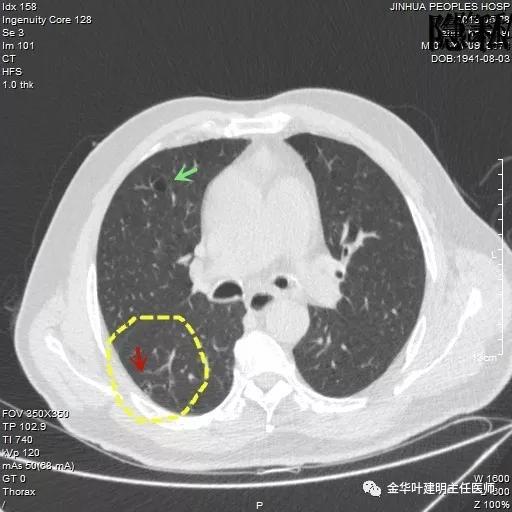警惕-会是简单的肺大泡吗？