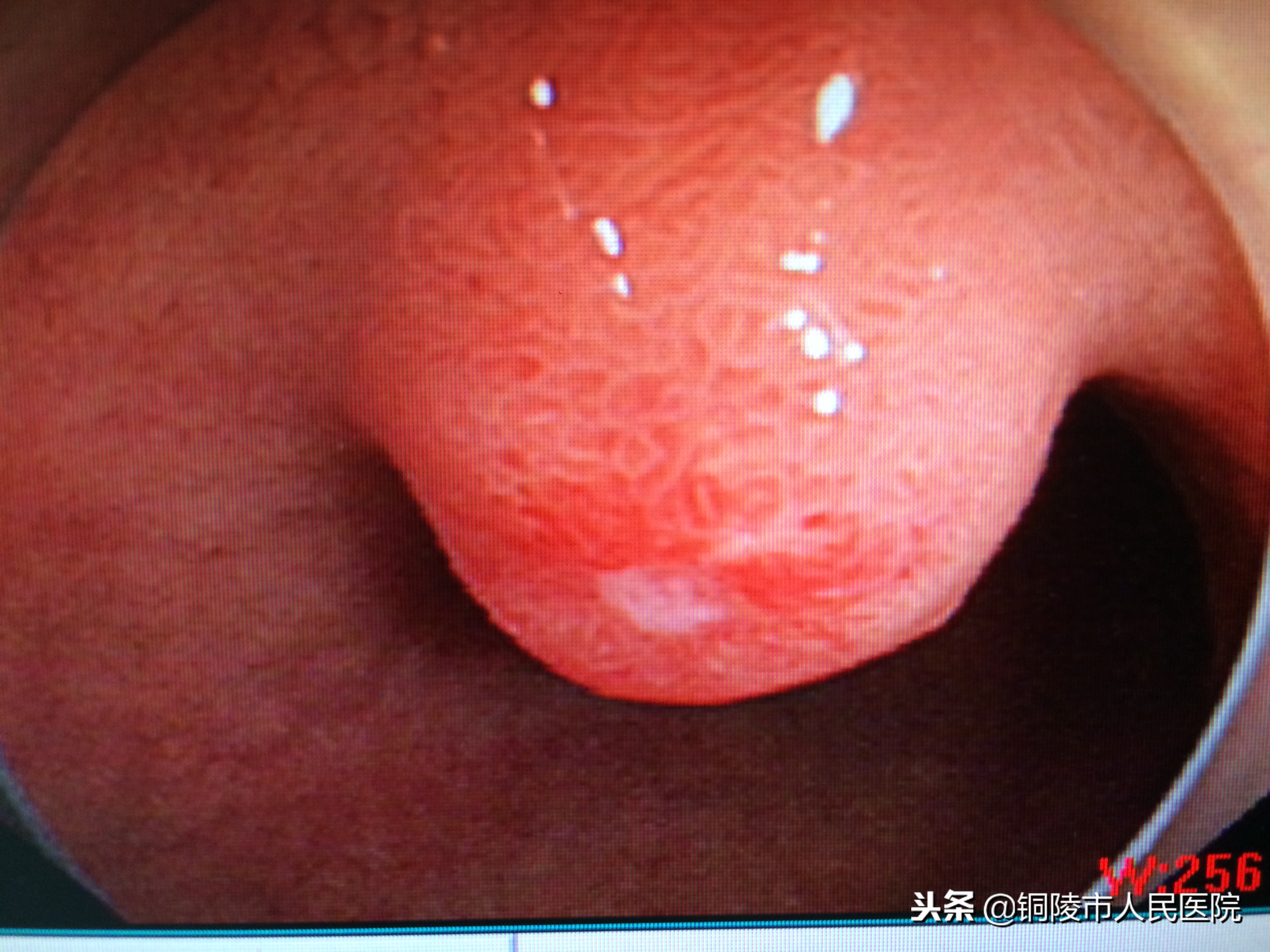 内镜行业的发展趋势,内镜目前发展现状