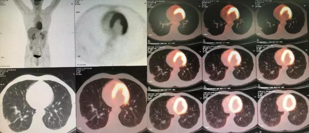 肺纤维化病例,肺纤维化手指甲发紫还能活多久