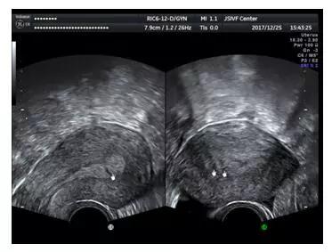 三维超声对宫腔粘连评估的重要性