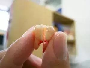 智齿发炎过程中为什么不能拔,智齿有发炎的经历了不拔可以吗